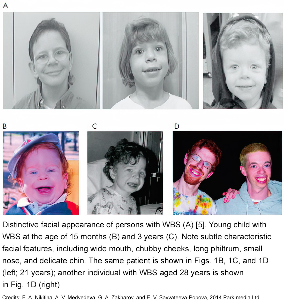 Children With Williams Syndrome: All You Need To Know